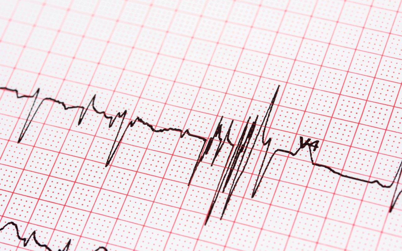 Prairie Cardiovascular adds new atrial fibrillation treatment