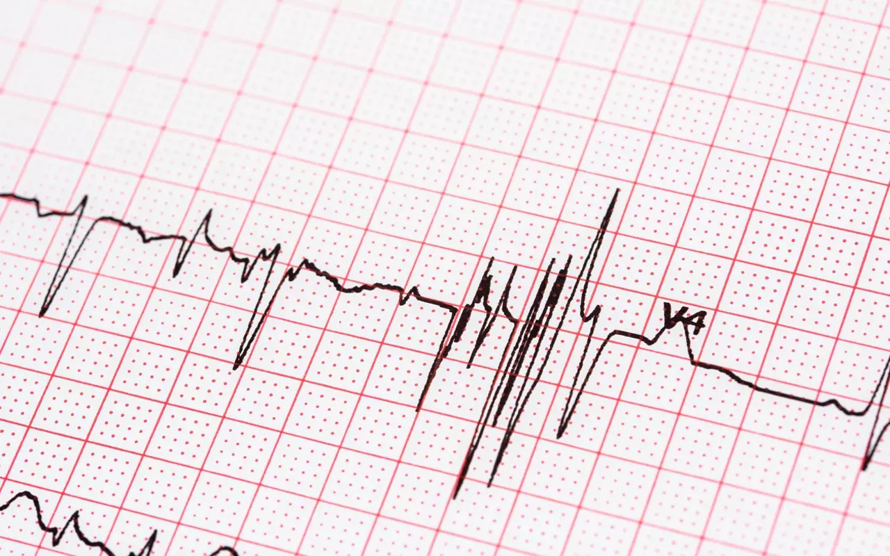Image: Prairie Cardiovascular adds new atrial fibrillation treatment